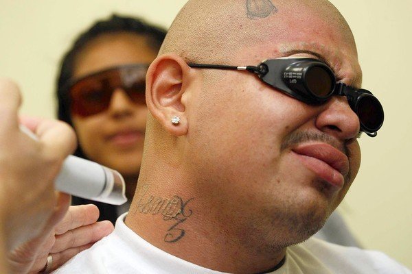 Tattoo Removal Los Angeles Tattoo Removal Training