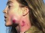 rubber bullet wound rubber bullet wound